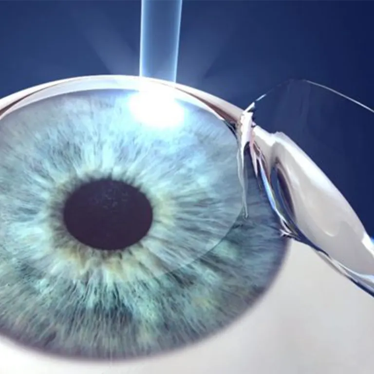 Cirurgia refrativa LASIK