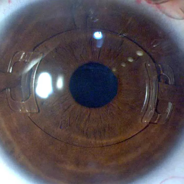 Cirurgia refrativa implante de lente intraocular fácica