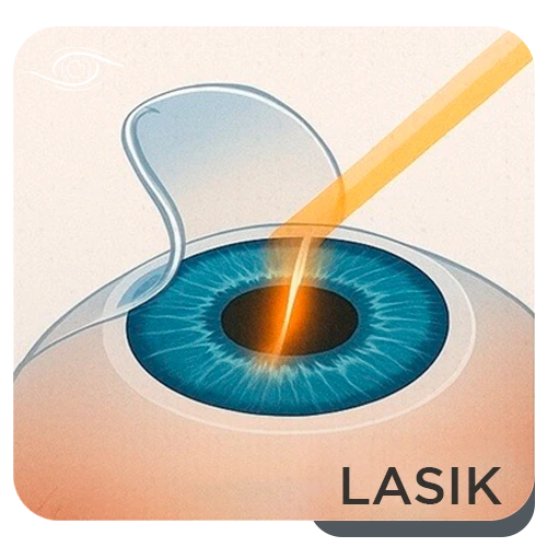 LASIK